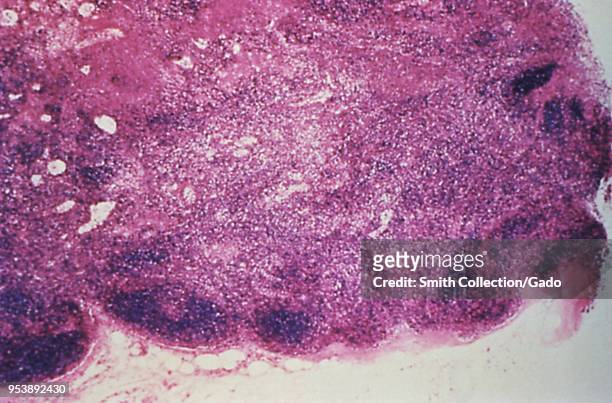 Lymph node cortex revealed in the micrograph image from a Hantavirus pulmonary syndrome patient, 1994. Image courtesy Centers for Disease Control .