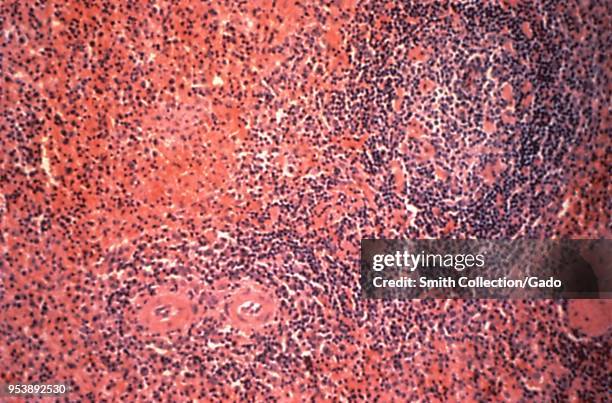 Splenic tissue revealed in the micrograph image from a Hantavirus pulmonary syndrome patient, 1994. Image courtesy Centers for Disease Control .