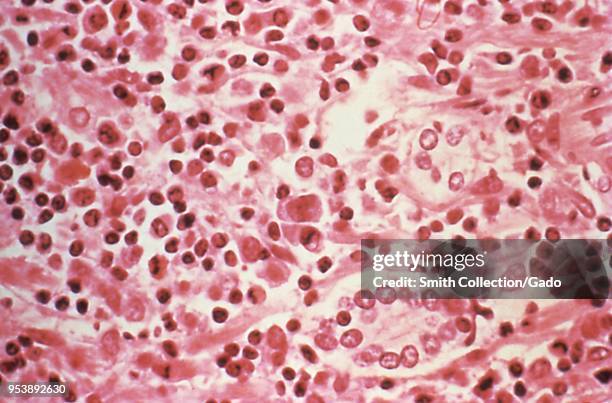 Liver tissue revealed in the micrograph image from a Hantavirus pulmonary syndrome patient, 1994. Image courtesy Centers for Disease Control .