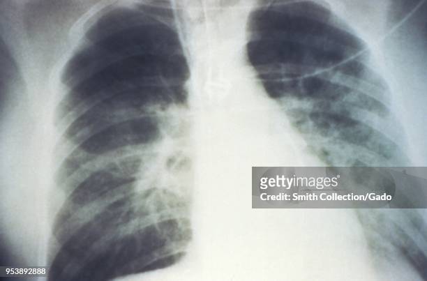 Mid-staged bilateral pulmonary effusion due to Hantavirus pulmonary syndrome , revealed in the AP chest x-ray, 1994. Image courtesy Centers for...