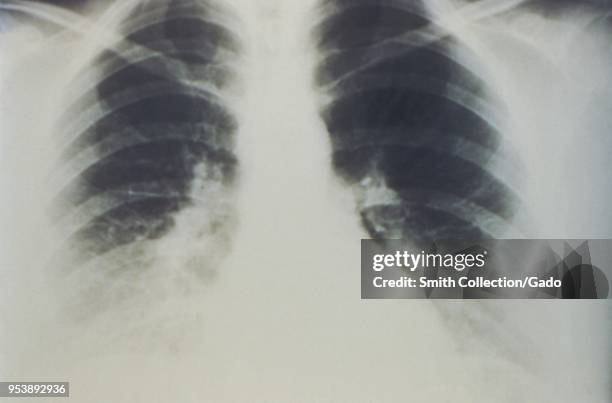 Early stages of bilateral pulmonary effusion due to Hantavirus pulmonary syndrome , revealed in the AP chest x-ray, 1994. Image courtesy Centers for...