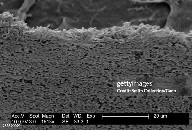 Gram-positive Clostridium difficile bacteria revealed in the stool sample micrograph film, 2004. Image courtesy Centers for Disease Control / Lois S....