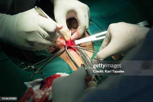 an appendectomy procedure held in the operating room - appendectomy stock pictures, royalty-free photos & images
