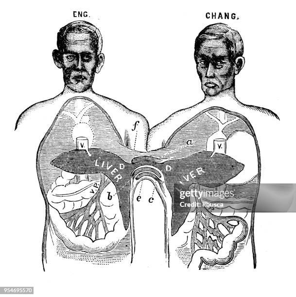 antique engraving illustration: siamese twins - conjoined twin stock illustrations