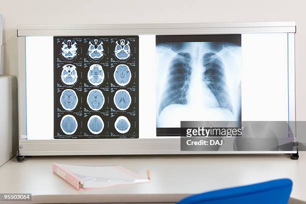 x-ray image and cat scan image on lightbox - panel de luz fotografías e imágenes de stock