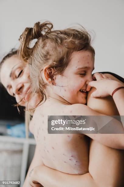 mother taking care of little girl with chicken pox - morbillivirus stock pictures, royalty-free photos & images