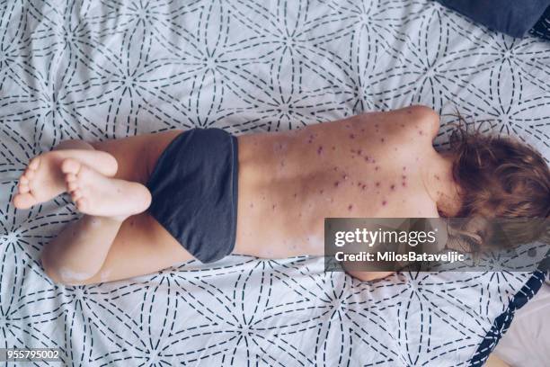 little girl with chickenpox - morbillivirus stock pictures, royalty-free photos & images