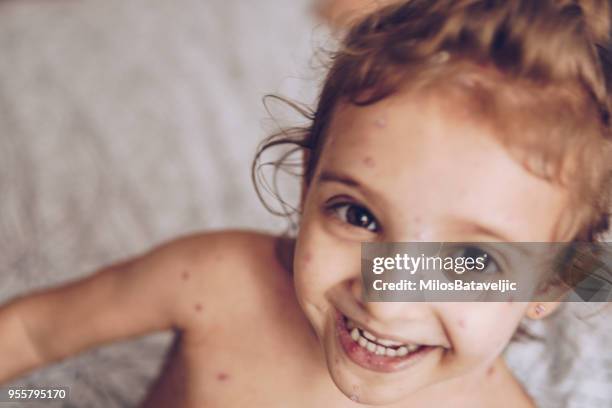 little girl with chickenpox - morbillivirus stock pictures, royalty-free photos & images