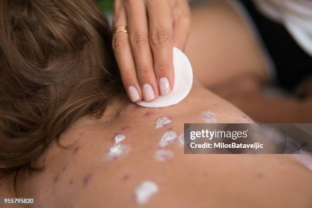 madre cuidando de la niña con varicela - varicela fotografías e imágenes de stock