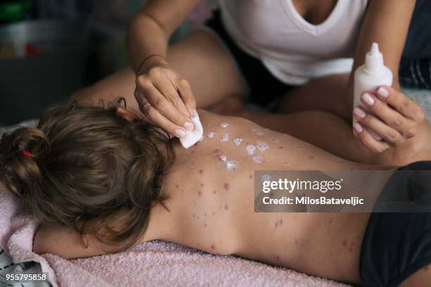 mother taking care of little girl with chicken pox - morbillivirus stock pictures, royalty-free photos & images