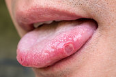 tongue with ulcers of adult man