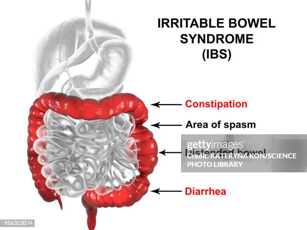 irritable bowel syndrome, illustration - diarrhea stock illustrations