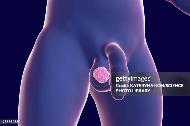 stockillustraties, clipart, cartoons en iconen met testicular cancer, illustration - cancer de piel