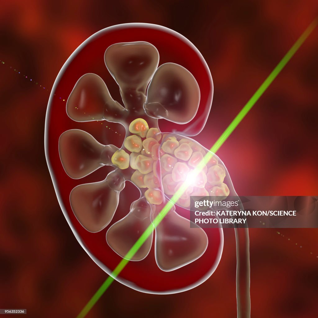 Kidney stone treatment, conceptual illustration