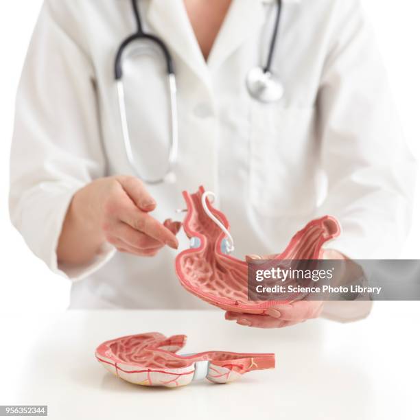 doctor with model of stomach with gastric band - gastric band treatment imagens e fotografias de stock