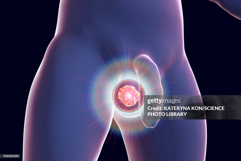 Testicular cancer treatment, illustration