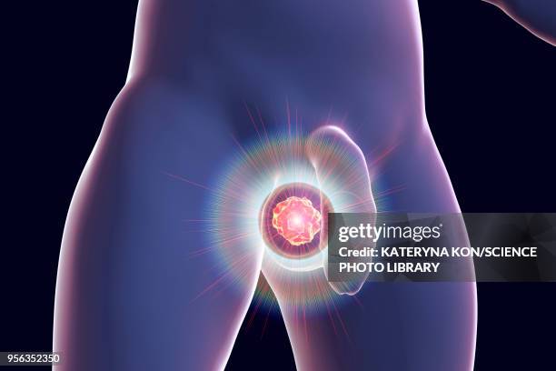testicular cancer treatment, illustration - gesticular stock illustrations