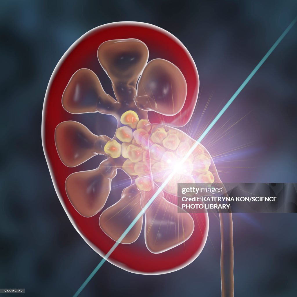 Kidney stone treatment, conceptual illustration