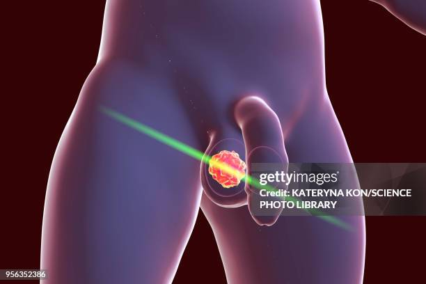 testicular cancer treatment, illustration - gesticular stock illustrations