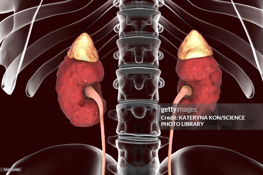 Chronic kidney disease, illustration