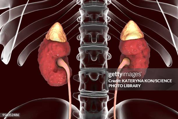 chronic kidney disease, illustration - cyst stock illustrations