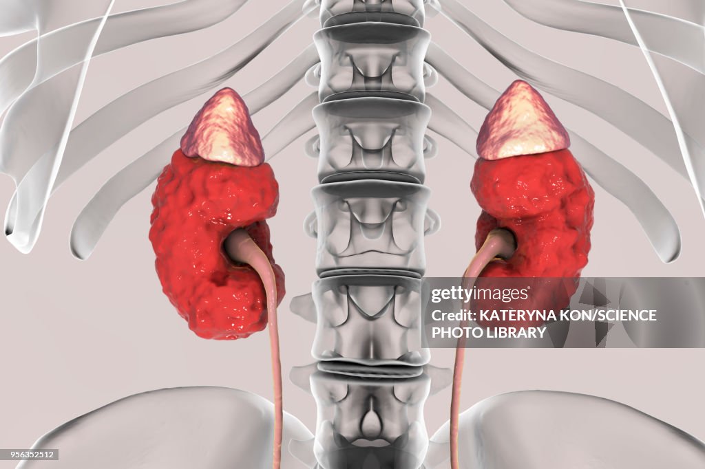 Chronic kidney disease, illustration