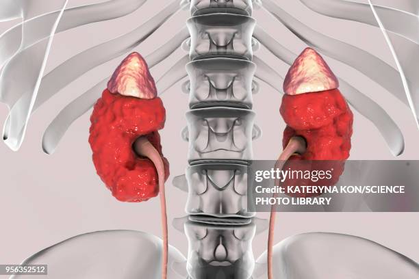 chronic kidney disease, illustration - cyst stock illustrations