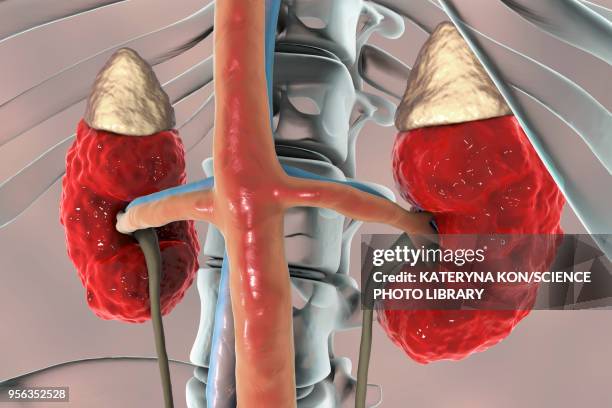 chronic kidney disease, illustration - cyst stock illustrations