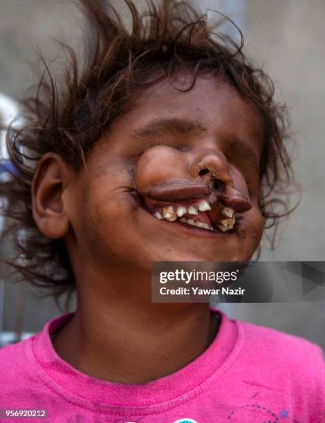 An Indian child beggar Arjun, 3 years old with the disfigured face, begs with his father on a roadside on May 10, 2018 in Srinagar, the summer...