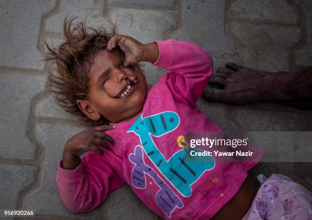 An Indian child beggar Arjun, 3 years old with the disfigured face, begs with his father on a roadside on May 10, 2018 in Srinagar, the summer...