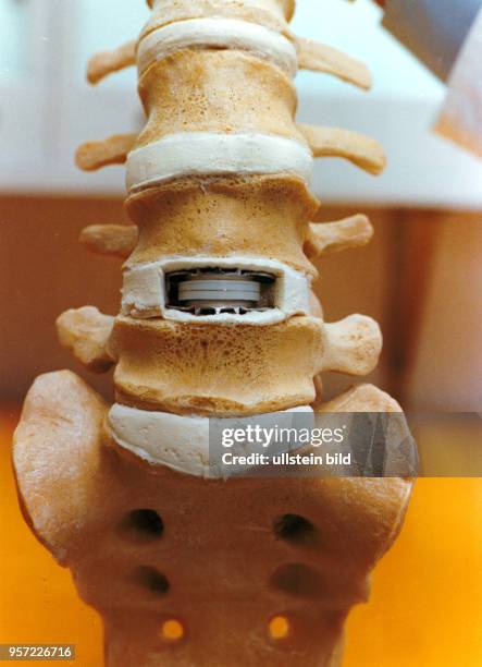 Ein Ausschnitt aus einem Wirbelsäulenmodell mit Darstellung der Ledenwirbelsäule und des Kreuzbeines mit einer künstlichen Bandscheibe im Segment 4/5...