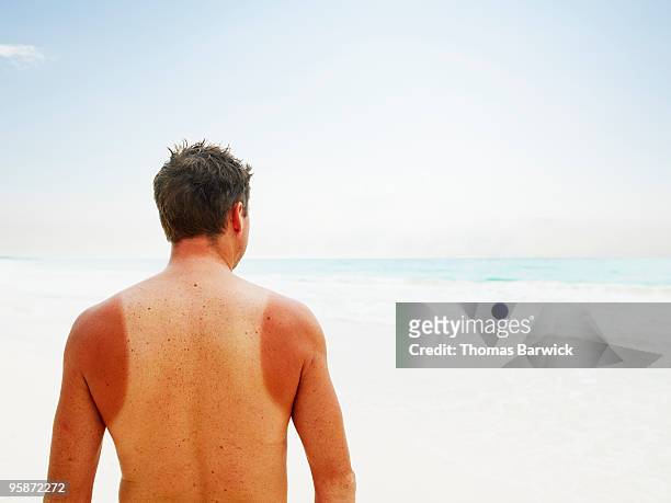 man with sun burn standing near water on beach - sunburn stock-fotos und bilder