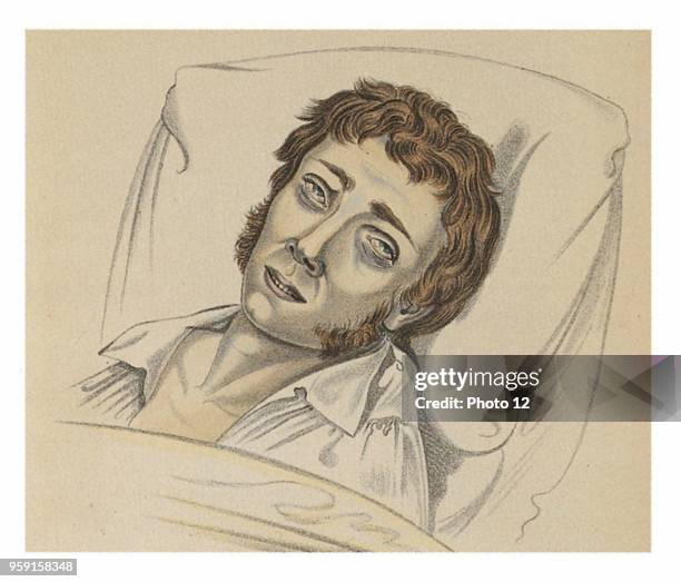 Victim of cholera, from the work Physionomy of sick persons , by professor K.H. Baumgartner.