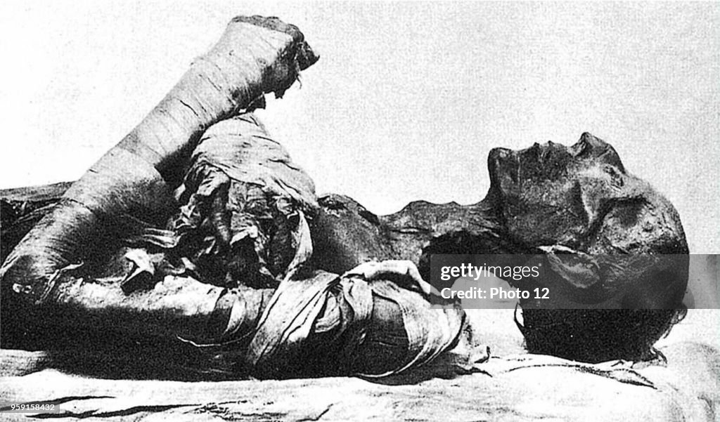 Mummy of Pharaoh Ramses II, who died of smallpox.