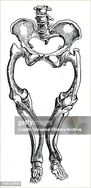 Engraving depicting part of a male skeleton showing the effects of Rickets on the leg bones. Rickets is defective mineralisation or calcification of...