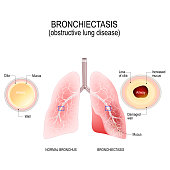 Normal bronchus and bronchiectasis.