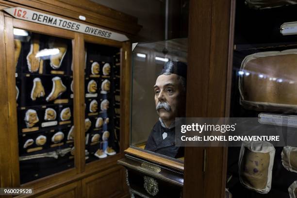 Picture taken on May 17, 2018 shows the statue of French wax moulder and curator Jules Baretta at the museum casts of people suffering dermatological...