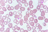 Abnormal red blood cells from anemia patient