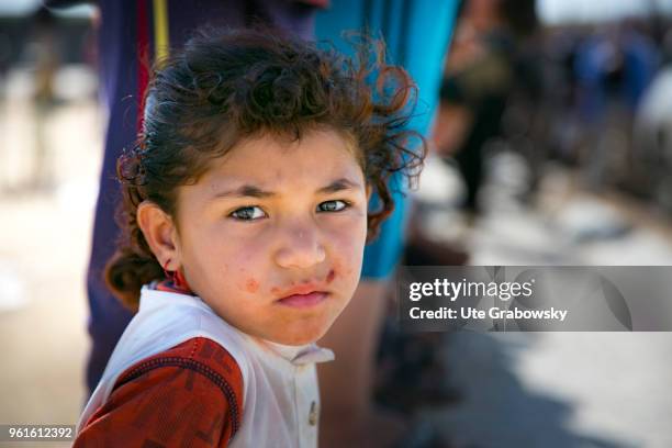 April 23: A little girl with facial wounds in the refugee camp Kabarto 2 in the District Semeel on April 23, 2018 in DOHUK, IRAQ. People suffer from...