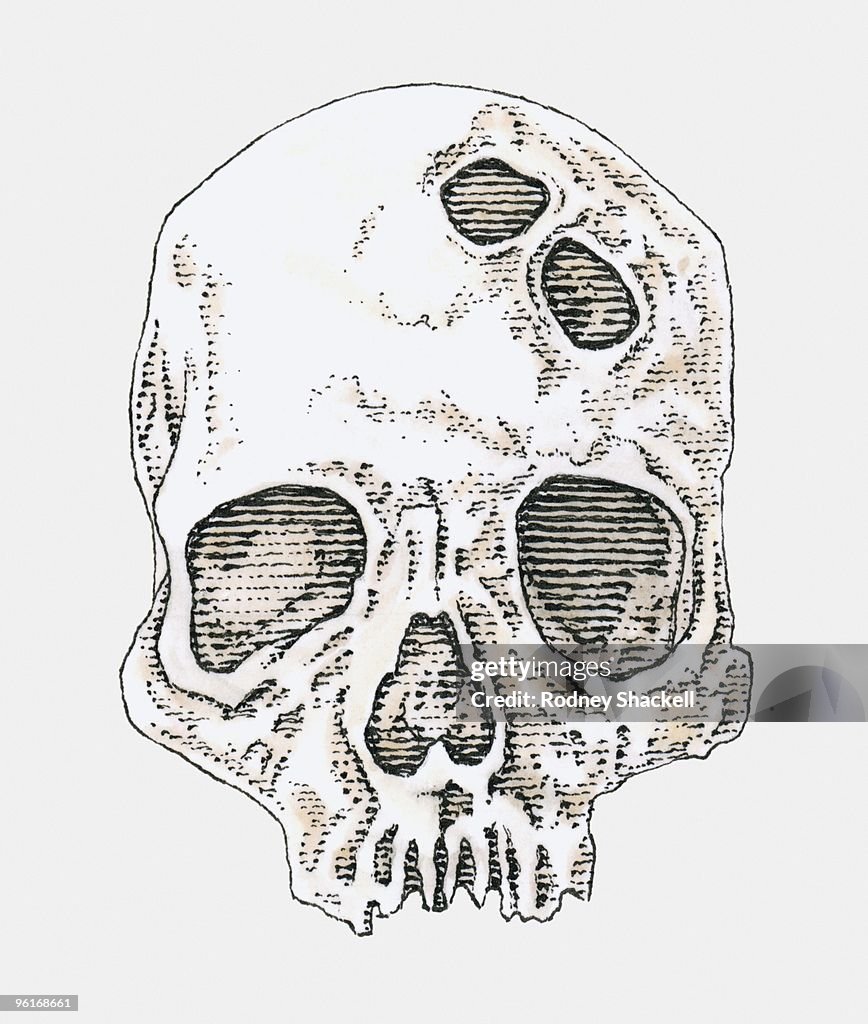 Black and white illustration of trepanning holes in human skull