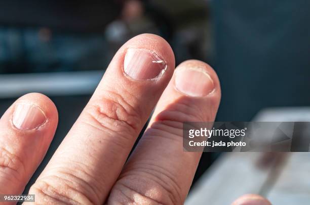 nail torn off a finger - broken finger ストックフォトと画像