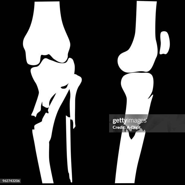 stockillustraties, clipart, cartoons en iconen met gebroken knie gebroken - bot in het been