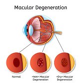 Macular Degeneration Vector Medical Scheme