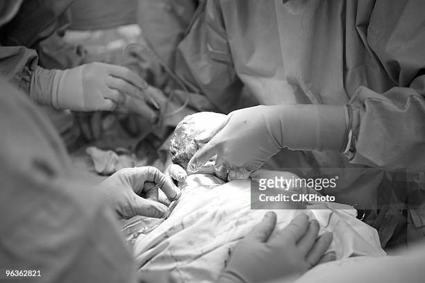 caesarean section birth - caesarean section stock pictures, royalty-free photos & images