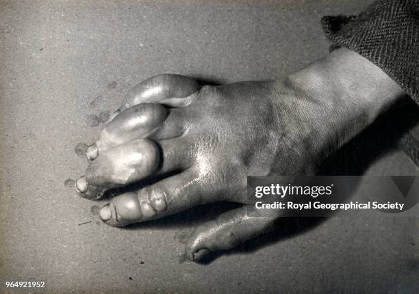 Dr Atkinson's frostbitten hand, Antarctica, 5th July 1911. British Antarctic Expedition 1910-1913.