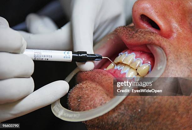 Male tourist is getting a teeth bleaching and soft whitening treatment at the dental spa clinic at Clafouti hotel in Varkala on January 08, 2010 in...