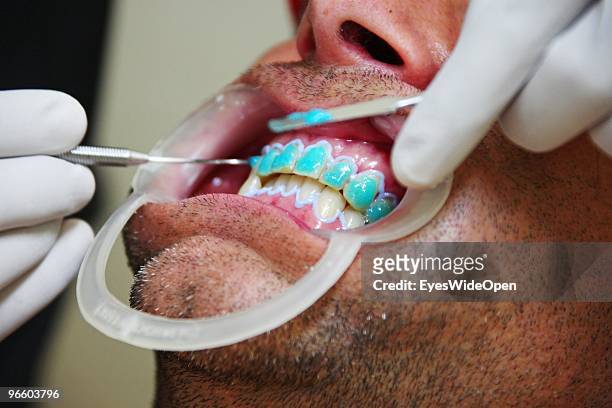Male tourist is getting bleaching gel on his teeth for a soft whitening treatment at the dental spa clinic at Clafouti hotel in Varkala on January...