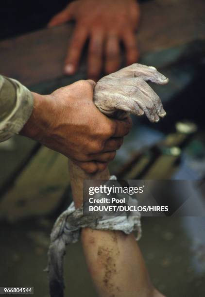 Sauvetage d'Omeyra, une fillette prisonnière de décombres après l'éruption du volcan Nevado del Ruiz à Armero le 15 novembre 1985 à Armero, Colombie.