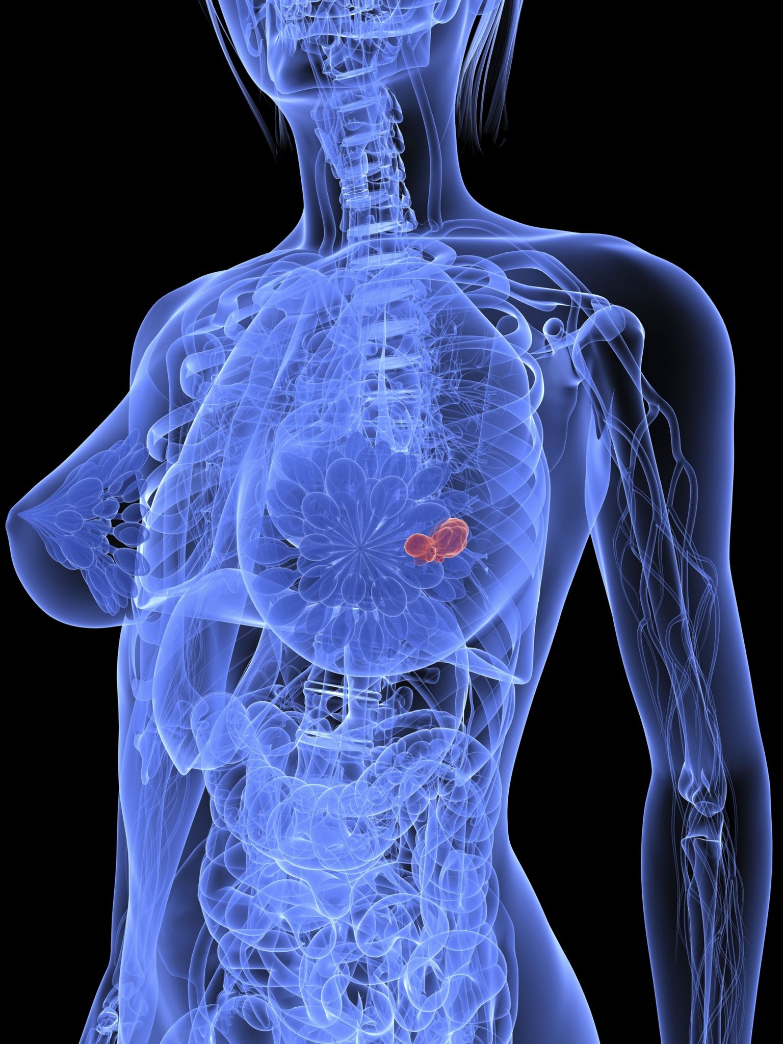 tumor feminino