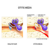 Otitis media. Human anatomy.